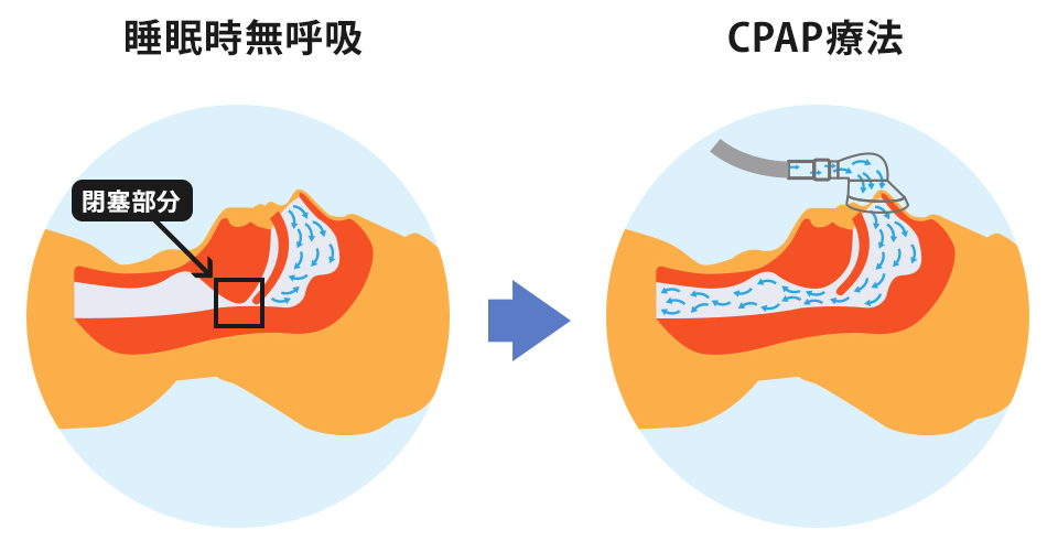 CPAP治療の図