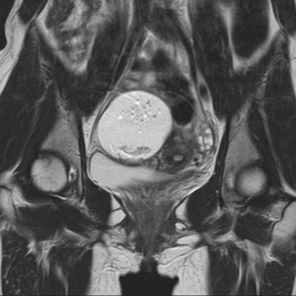 卵巣奇形嚢腫のMRI写真